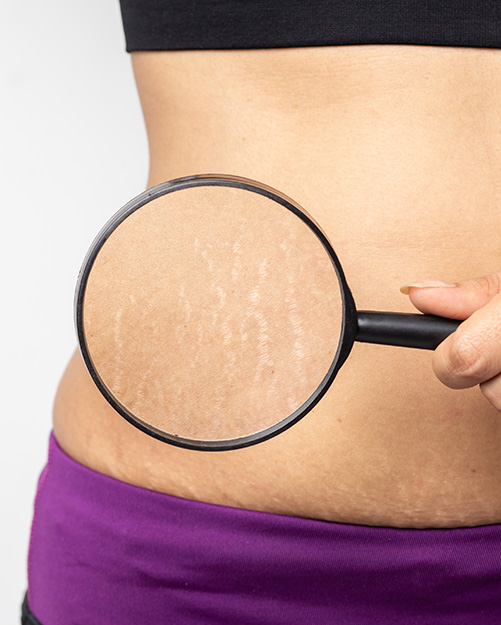 Stretch Marks - Aesthetic Clinic In Gurgaon| Aesthetics Redefined by Cocoona